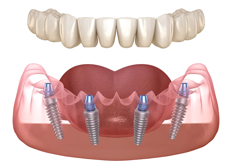 All-on-4 dental implant procedure at Dental Clinic Your Smile, transforming smiles with advanced dental care